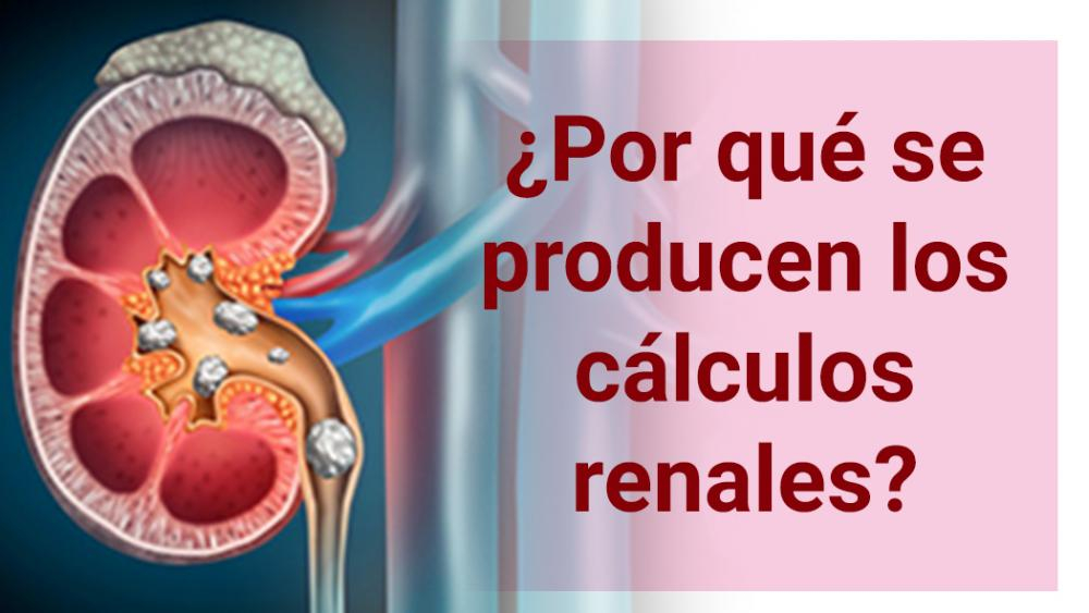 ¿Por qué se están produciendo los cálculos renales?